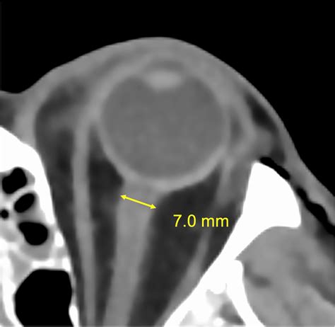 CT image on the optic nerve sheath demonstrating the technique of ...