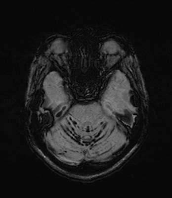 Superficial Siderosis : Importance of Susceptibility MRI Imaging - Blogs