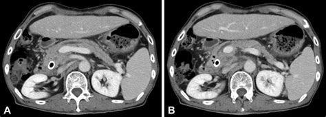 Abdominal Ct Reveals A Main Pancreatic Duct Stricture In The Head Of Download Scientific