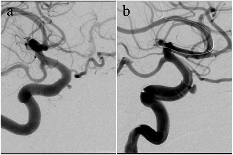 Pipeline Embolization For An Iatrogenic Intracranial Internal Carotid