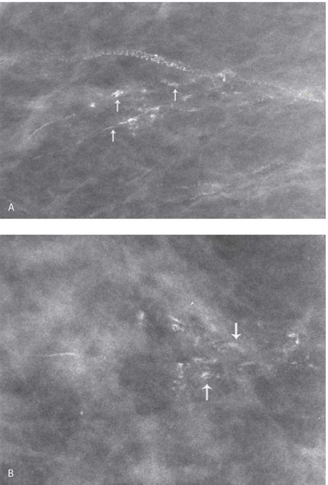 Breast Calcifications Radiology Key