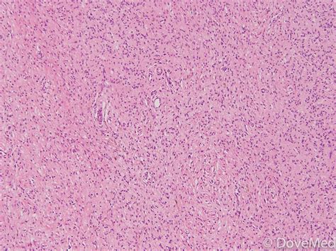 Neurofibroma Histology