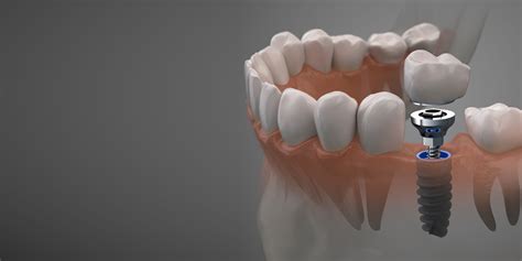 Dental Implants Middletown NY Teeth4You Implant Center