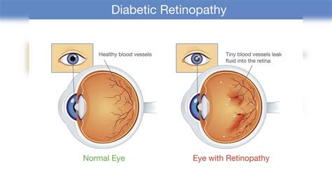 Diabetic Retinopathy Signs And Symptoms Stages And Treatment