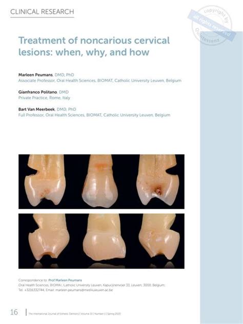 Tratamiento De Lesiones Cervicales No Cariosas Ddc Odontolog A Udocz