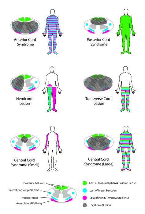 Spinal Cord Injuries Storymd