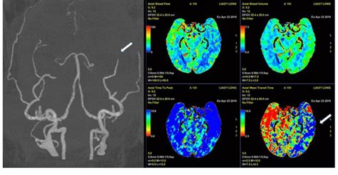 Post Contrast Cerebral Computed Tomography Angiography And Perfusion Download Scientific