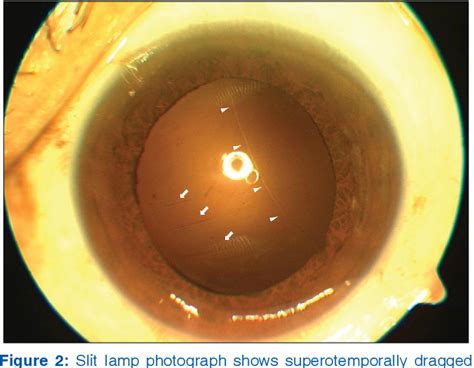 Figure From Dislocation Of Polyfocal Full Optics Accommodative