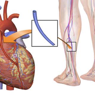 Pdf Pathobiology Of Saphenous Vein Grafts