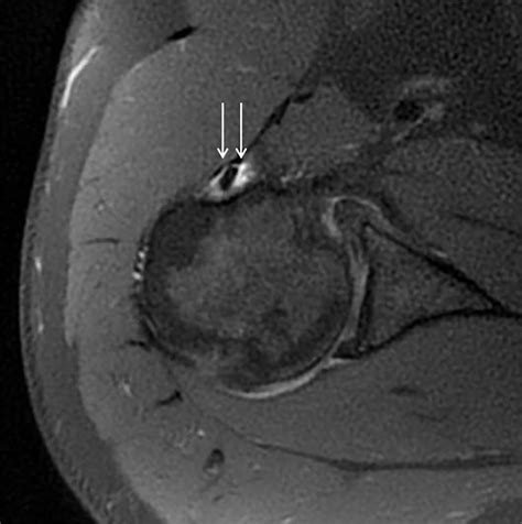 Radiologic And Histologic Evaluation Of Proximal Bicep Pathology In