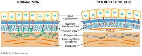 Castle Creek Biosciences D Fi Gene Therapy Castle Creek Biosciences