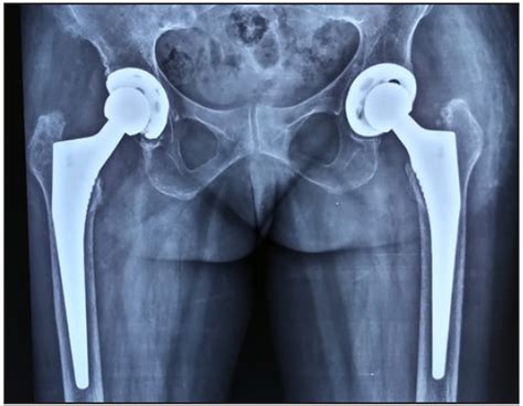 Comparative Study Of Pre Operative Operative And Post Operative