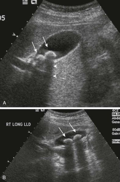 Cholelithiasis Ultrasound