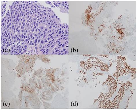 Liver mass biopsy. (a) H&E staining indicative of poorly differentiated... | Download Scientific ...