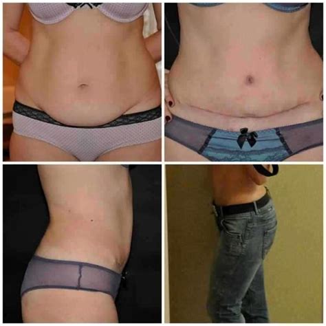 Scars After Tummy Tuck Tummy Tuck Prices Photos Reviews Info Qanda