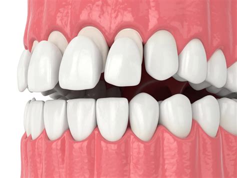 5 Types Of Veneers Procedure Cost And Side Effects