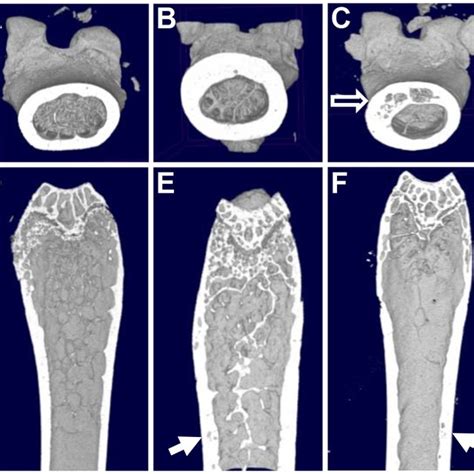 Bone Scan 99mtc Hmdp Anterior View Showing Diffuse And Severe