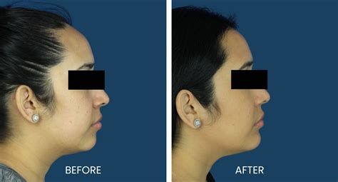 Platysmaplasty - Plano Plastic Surgery