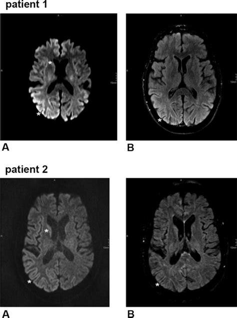 Rapid Progressive Visual Decline And Visual Field Defects In Two