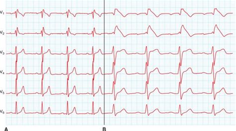 Ecg Criteria And Drug Challenge As Diagnosis For Brugada Syndrome