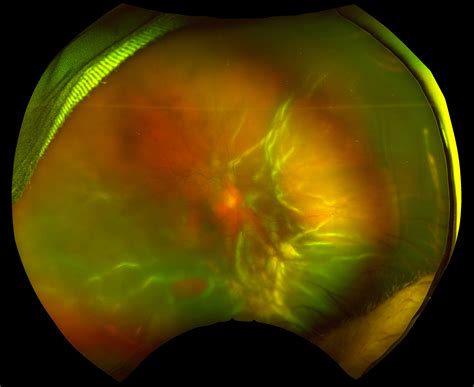 Retinal Detachment Surgery In The Aging Eye Retina Today