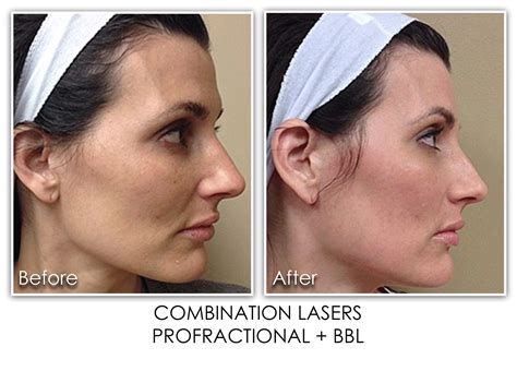 1 Combination Laser Skin Rejuvenation Clinic Skin Rejuvenation Clinic