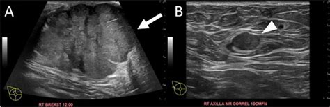 A Targeted Right Breast Ultrasound In The Transverse Plane Shows A