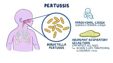 Video: Pertussis: Nursing