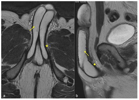 MRI-Cavernosography: A New Diagnostic Tool for Erectile Dysfunction Due