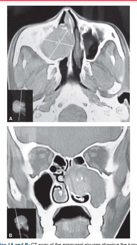 Figure From Capillary Hemangioma Of The Maxillary Sinus A Case