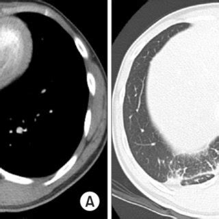 A B A Follow Up Contrast Enhanced Computed Tomography Examination At