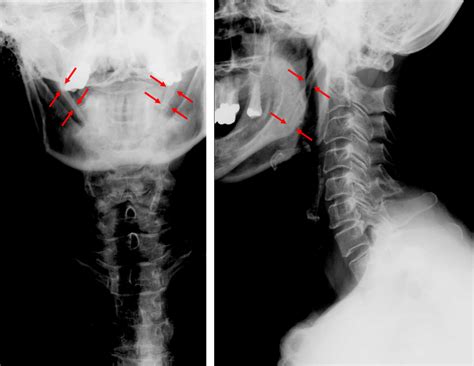 Eagle syndrome - Wikipedia