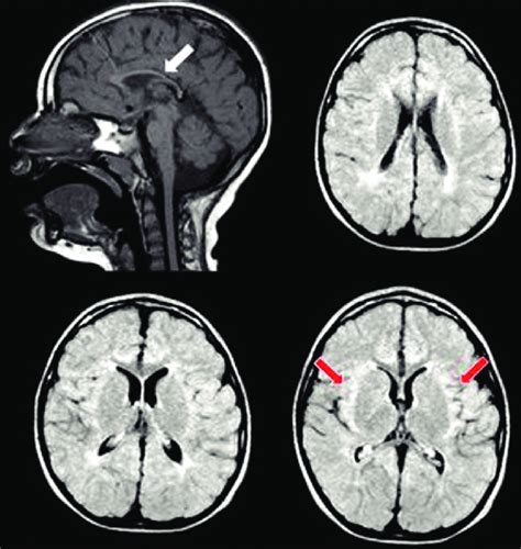 Brain Magnetic Resonance Imaging Showing Thin Corpus Callosum White