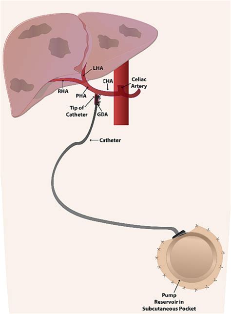 imaging   hepatic arterial infusion pump primer  radiologists