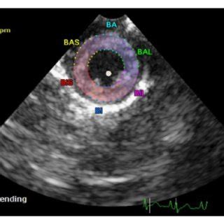 Speckle Tracking Echocardiography At The Level Of The Cardiac Base In A