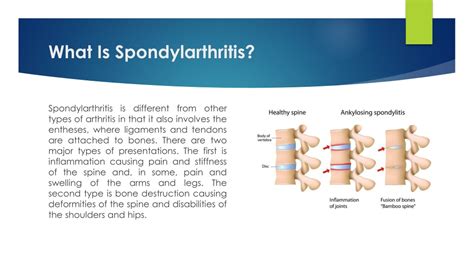 PPT - How Is Spondylarthritis Diagnosed And its treatment PowerPoint Presentation - ID:12659651