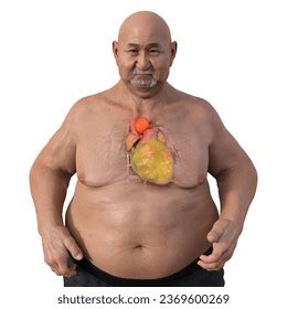 3d Scientific Illustration Depicting Obese Man Stock Illustration 2369600269 | Shutterstock