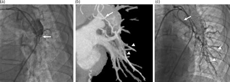 A Selective Pulmonary Angiography B Timeresolved 4D CT