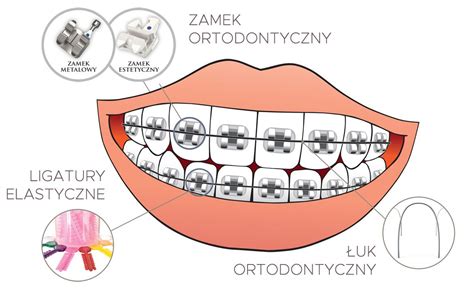 Etapy Leczenia Ortodontycznego Rock Your Smile Centrum Ortodontyczne