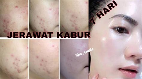 TAK PERLU PAKAI SKINCARE MAHAL INI CARA MENGOBATI JERAWAT BATU DAN