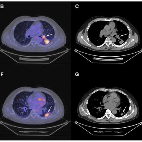 Chest CT Scan And Fused PET CT Images Of The Masses On April 28th