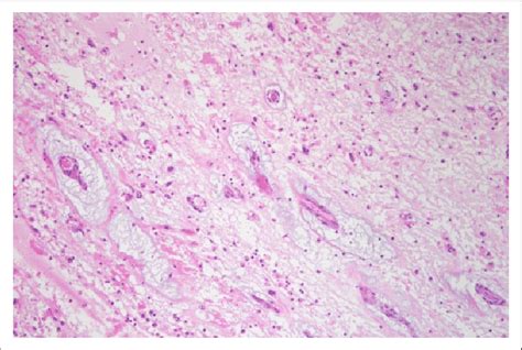 Histologic Examination Showed Spindle Shaped Cells And Stellate Cells Download Scientific