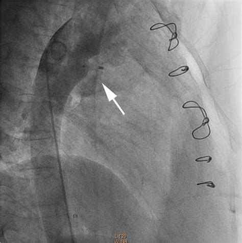 Figure 2 From Small Residual Patent Ductus Arteriosus After Surgical