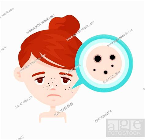 Acne Black Spots Infographic Vector Modern Flat Style Cartoon