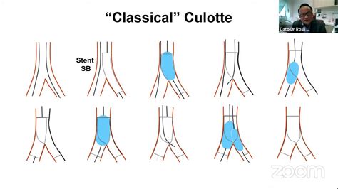 Apsc Cme Series Bifurcation Workshop On Culotte Stenting Youtube