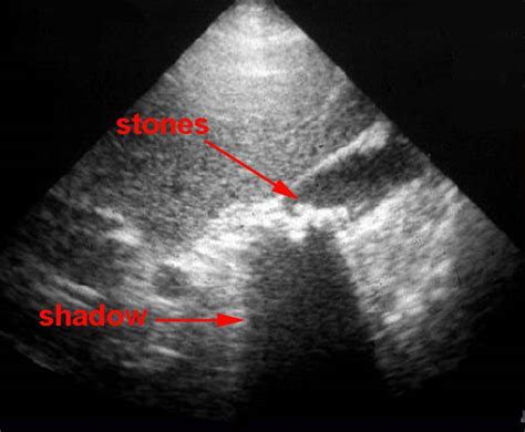 Cholelithiasis Ultrasound