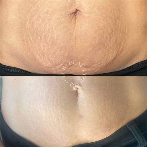 Inkless Stretch Mark Removal And Revision Isr Treatment