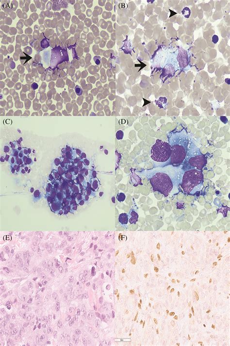 A B Circulating Rhabdoid Tumor Cells In Blood Wright S Stain