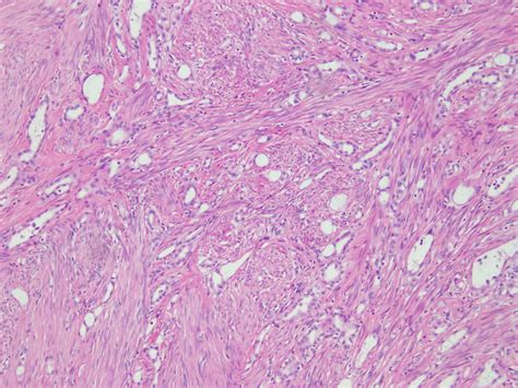 Pathology Outlines Adenomatoid Tumor