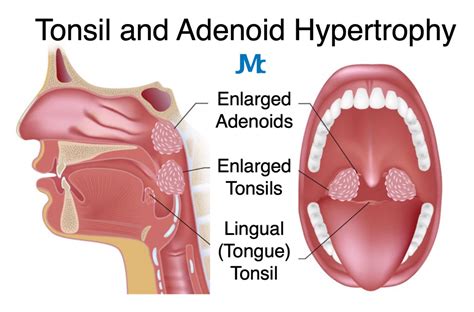 Tonsillectomy And Adenoidectomy Before And After